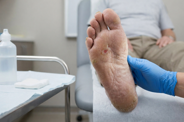Pie Diabético: 5 Señales de Alarma que No Debes Ignorar