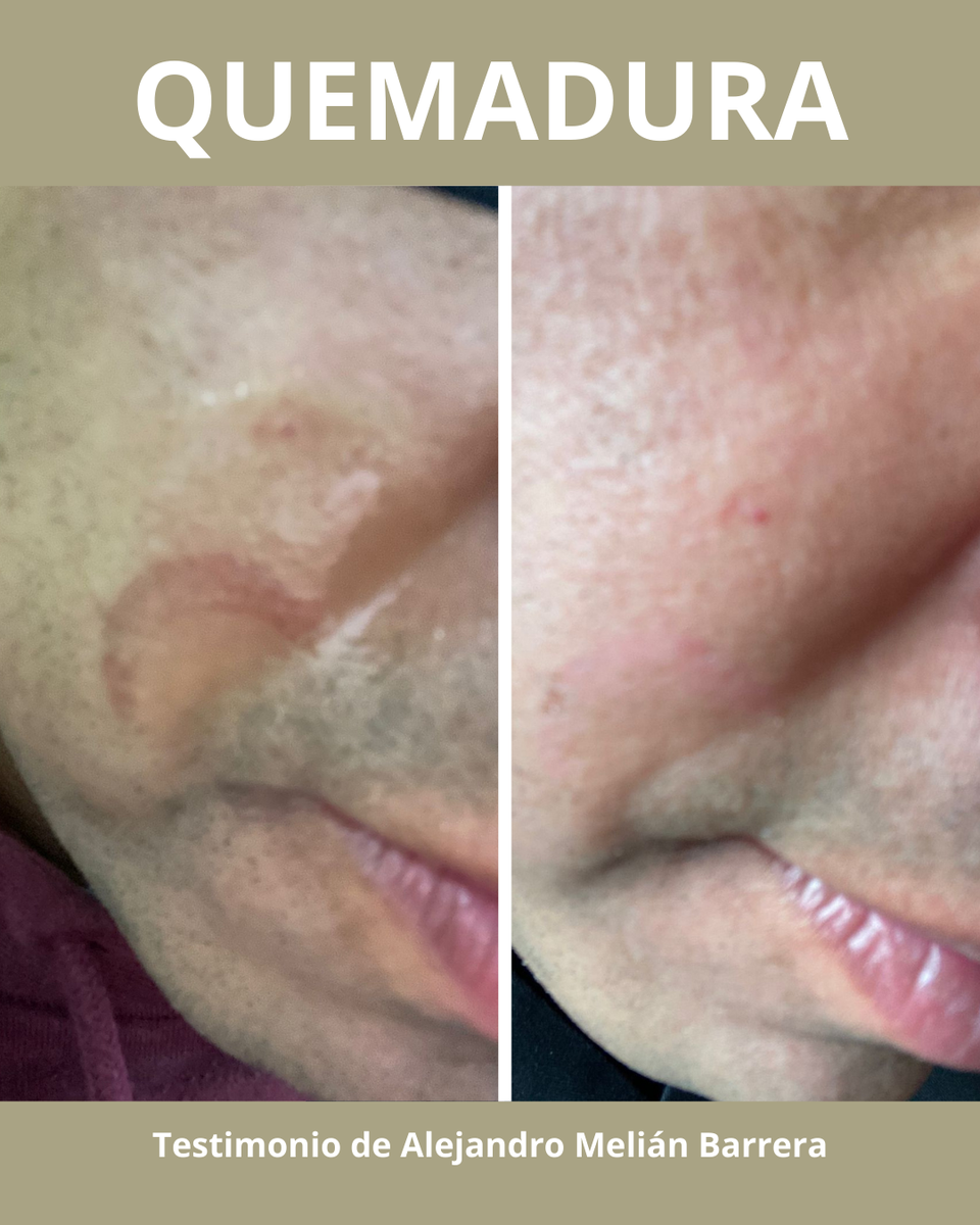 Crema Regeneradora y Protectora Natural Pielawén | Reparación Intensiva de la Piel – Chiloé